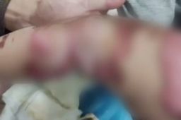 1岁男童尿床被电热毯烧成重伤
