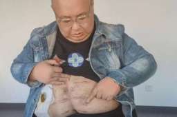 南京胖哥见义勇为后失去肛门功能