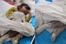 4岁女孩被虐待 父亲及其女友被控制