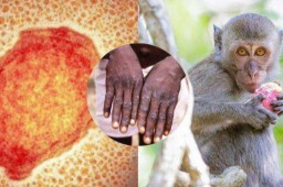 重庆发现1例境外输入猴痘病例