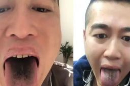 男子确诊后舌头牙齿全变黑