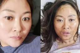 女子感染新冠高烧后满脸发黑