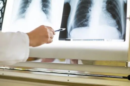 男子退烧第二天返岗 就医时接近白肺