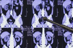 程序员20年喝近2吨可乐屡患结石