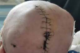 婴儿出生后颅骨骨折 医院回应